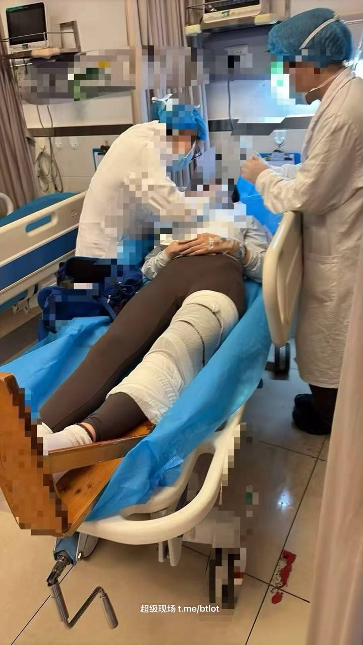 #女骑士 #车祸 #断腿 废了 @kxiha 估计是粉碎性骨折 !(图片 2/5)